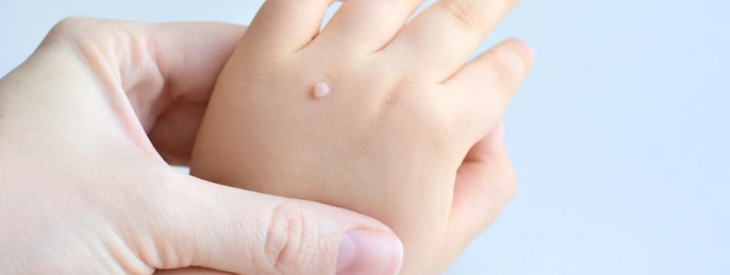 Siğillerin Doğal Yöntemlerle Giderilmesinde Yardımcı Olan Saf Yağlar Nelerdir? Siğillerin Doğal Yöntemlerle Giderilmesinde Yardımcı Olan Saf Yağlar Nelerdir?