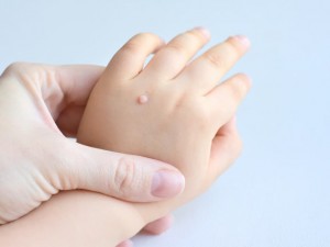 Siğillerin Doğal Yöntemlerle Giderilmesinde Yardımcı Olan Saf Yağlar Nelerdir?