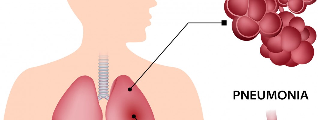 Hangi Uçucu Yağlar Zatürre Kontrolüne Yardımcı Olur? Hangi Uçucu Yağlar Zatürre Kontrolüne Yardımcı Olur?